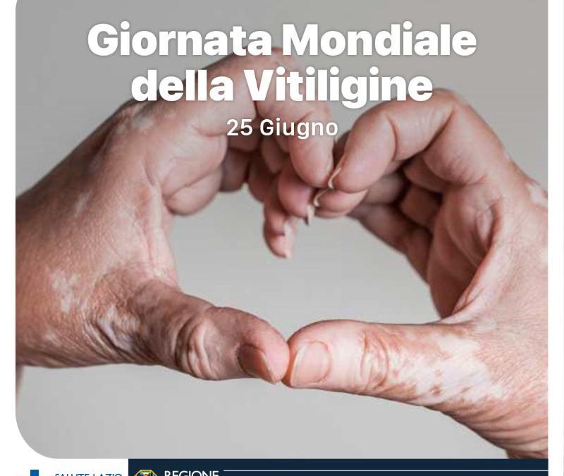 25/06/2023 – GIORNATA MONDIALE DEDICATA ALLA VITILIGINE – www.salutelazio.it