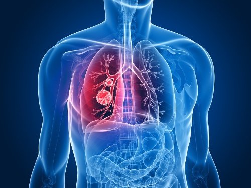 Tumori, per Agenas la rete oncologica toscana è al primo posto in Italia 
						 – www.toscana-notizie.it