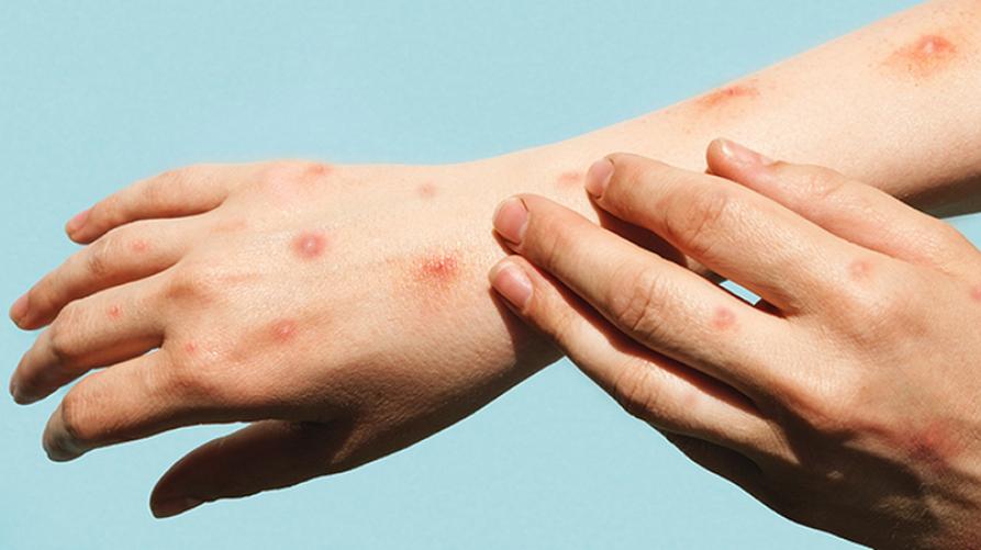 Vaiolo delle scimmie, nuove indicazioni con la circolare della Regione Piemonte
 – www.regione.piemonte.it